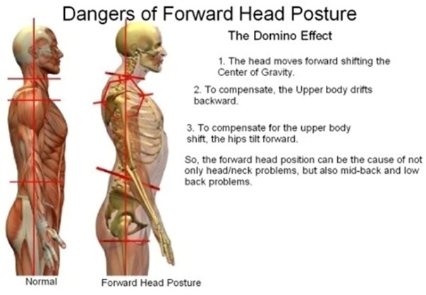 Forward-Head-Posture